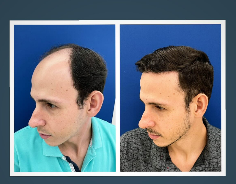 Pacientes Dra Renata lages Dermatologista transplante capilar montes claros
