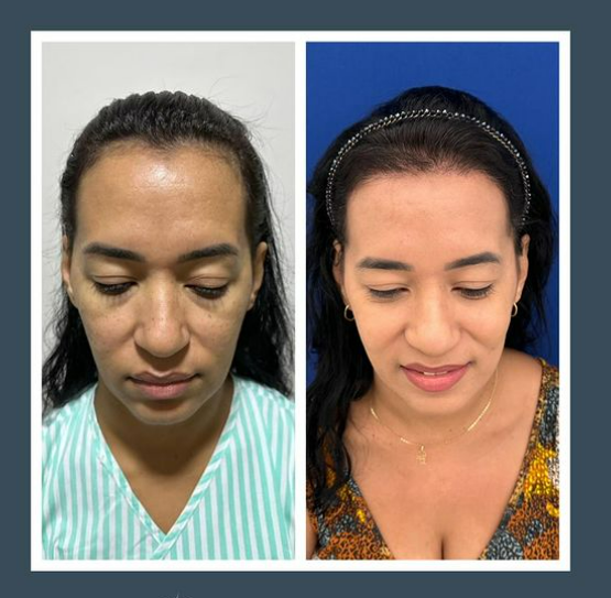 Transplante Capilar FUE Dra Renata lages Dermatologista transplante capilar montes claros