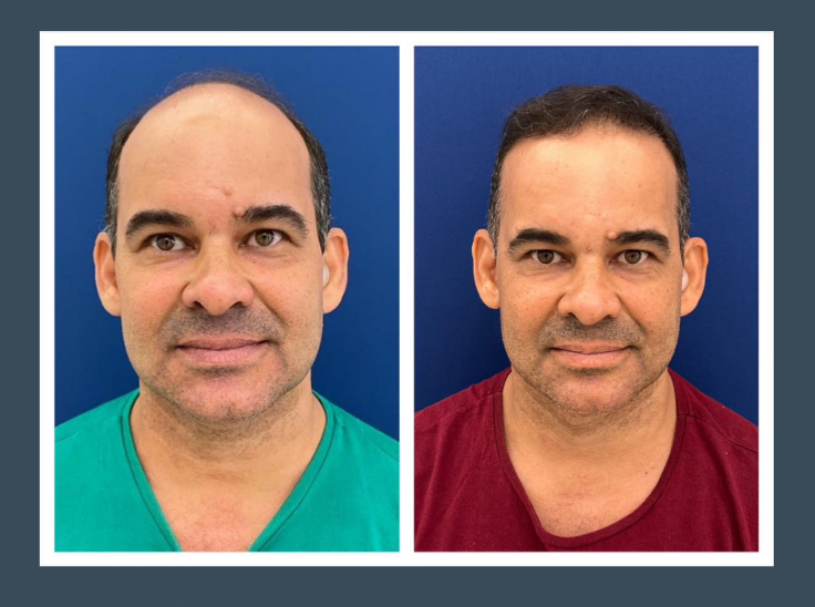 Infiltração intralesional Dra Renata lages Dermatologista transplante capilar montes claros