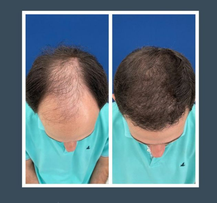 Mesoterapia/Intradermoterapia Dra Renata lages Dermatologista transplante capilar montes claros